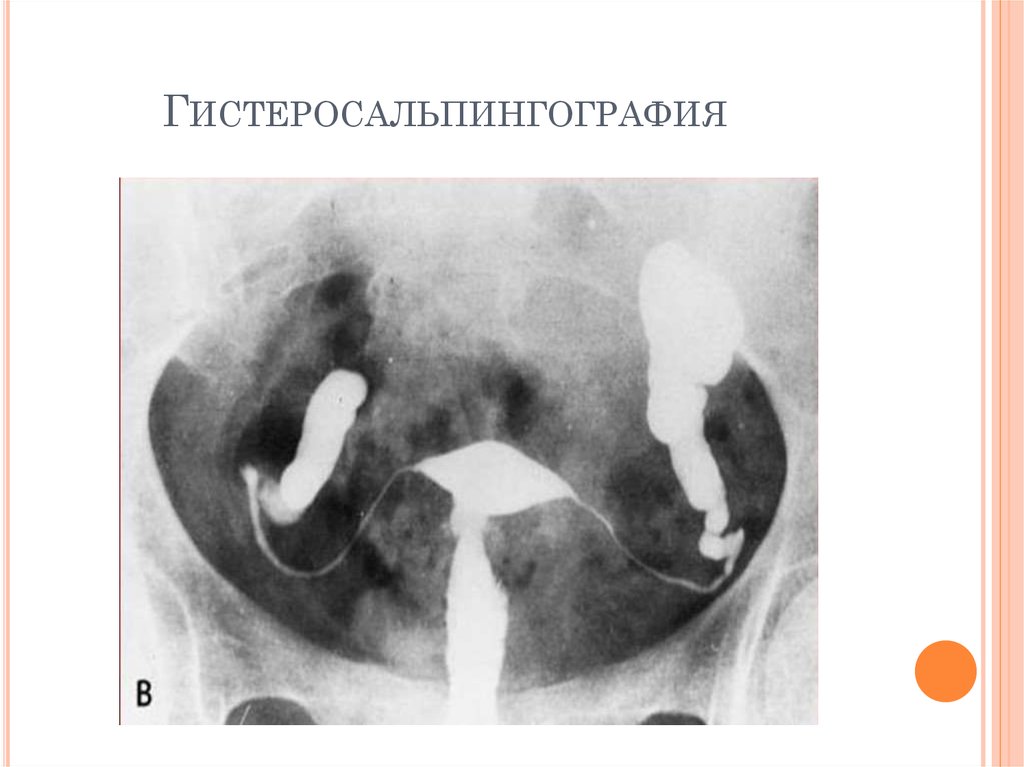 Повышенный проходимы. Гистеросальпингография туберкулез. Гидросальпинкс ГСГ рентген. Туберкулез маточных труб.