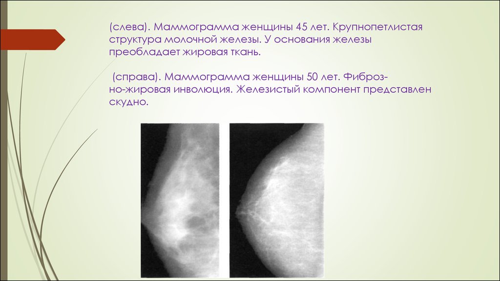 Молочная железа заболевания лечение. Фиброзно железистая ткань. Молочные железы железистая ткань. Маммография жировая инволюция. Фиброзная инволюция молочных желез маммография.