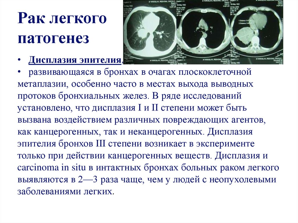 Рак легкого 5 см. Опухоли органов дыхания. Этиопатогенез опухоли легкого. Раковая опухоль легких этиология. Диагноз опухоль легкого.