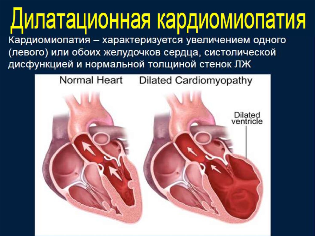 Кардиомиопатия сердца что это такое