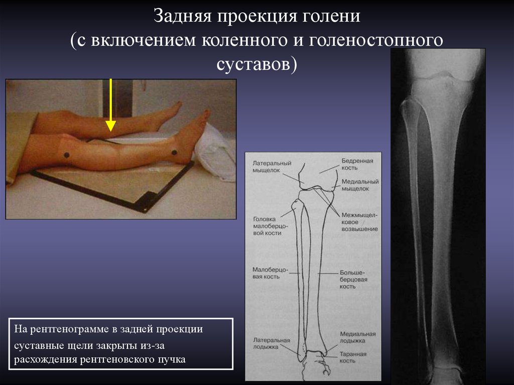 Суставы проекция. Рентген коленного сустава в аксиальной проекции. Рентгенография коленного сустава в прямой задней проекции. Рентгенограмма голени в двух проекциях. Аксиальный снимок коленного сустава.