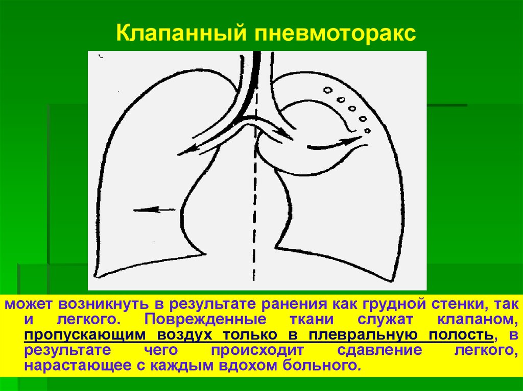 Клапанный пневмоторакс. Клапанный спонтанный пневмоторакс опасен. Клапанный пневмоторакс механизм развития. Клапанный пневмоторак. Напряженный клапанный пневмоторакс.