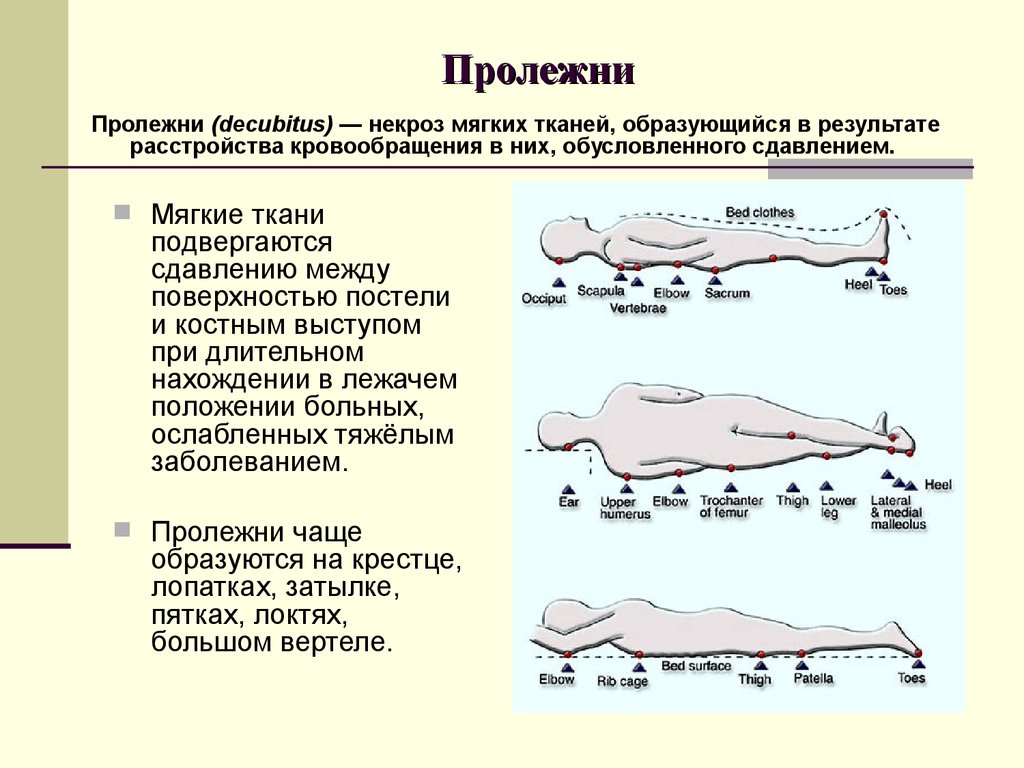 Места образования пролежней картинки