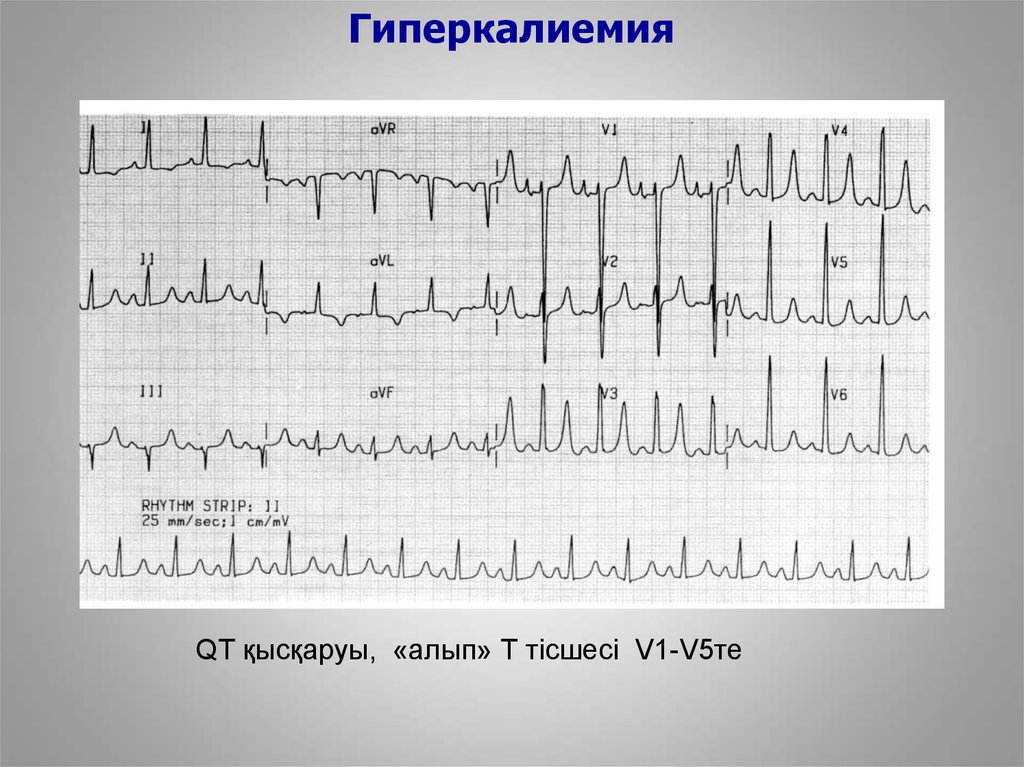 Гиперкалиемия экг картина