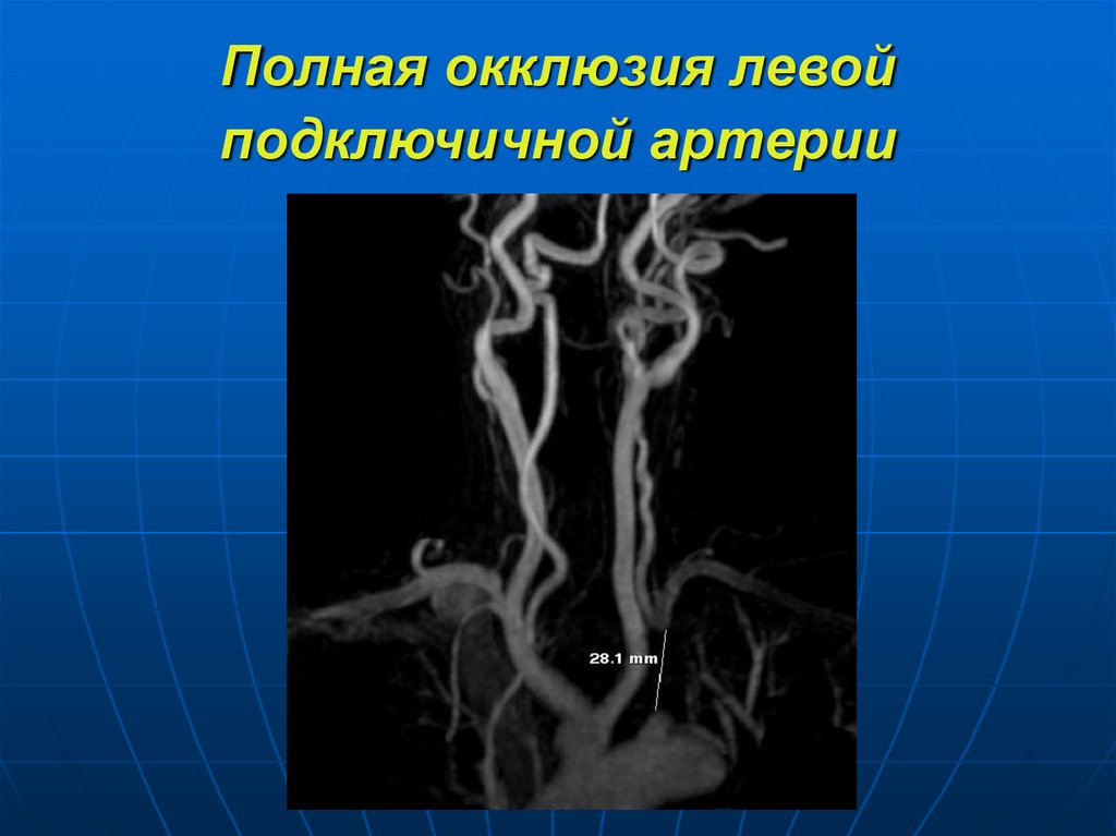 Гипоплазия позвоночной артерии слева