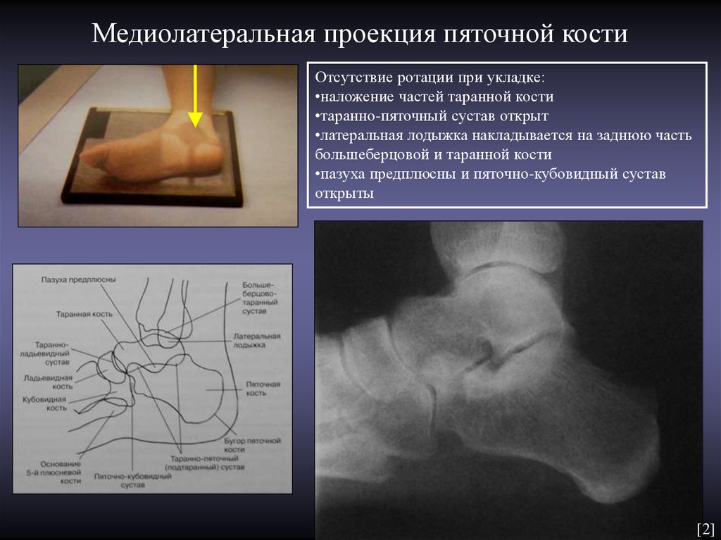 Пяточная кость. Пяточная кость рентген укладка. Рентгенография пяточной кости в проекции Бродена. Пяточная кость рентгеноанатомия. Пяточная кость в аксиальной проекции.