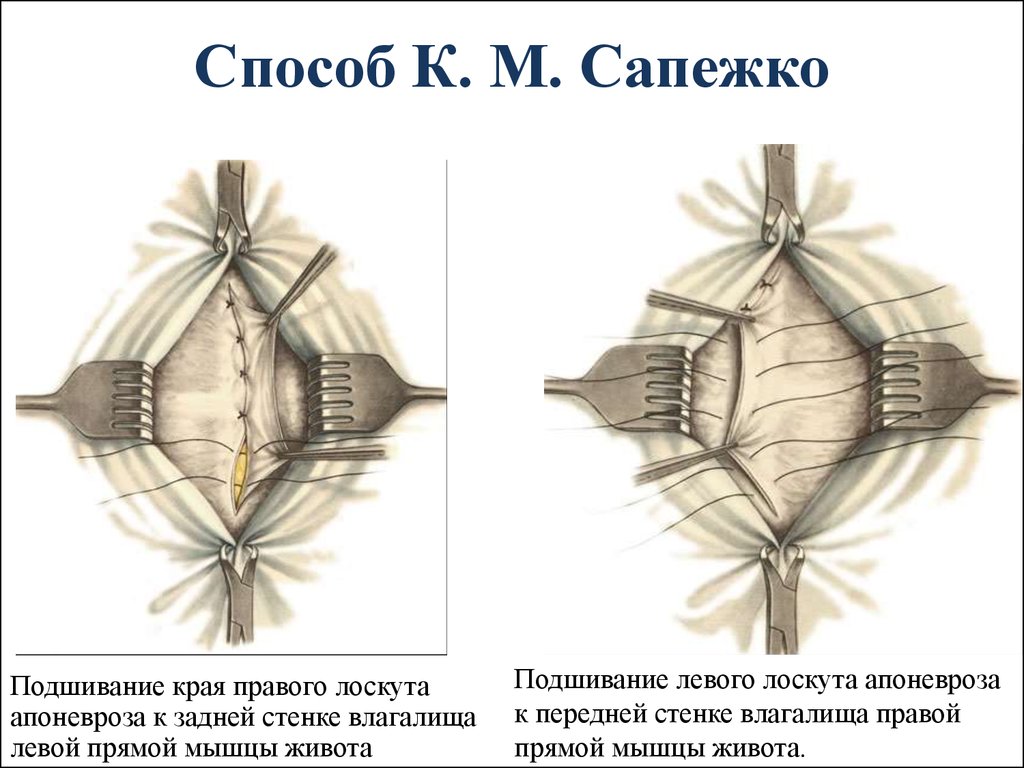 Операция белей. Грыжесечение по Сапежко и Мейо. Пластика пупочной грыжи по Сапежко.