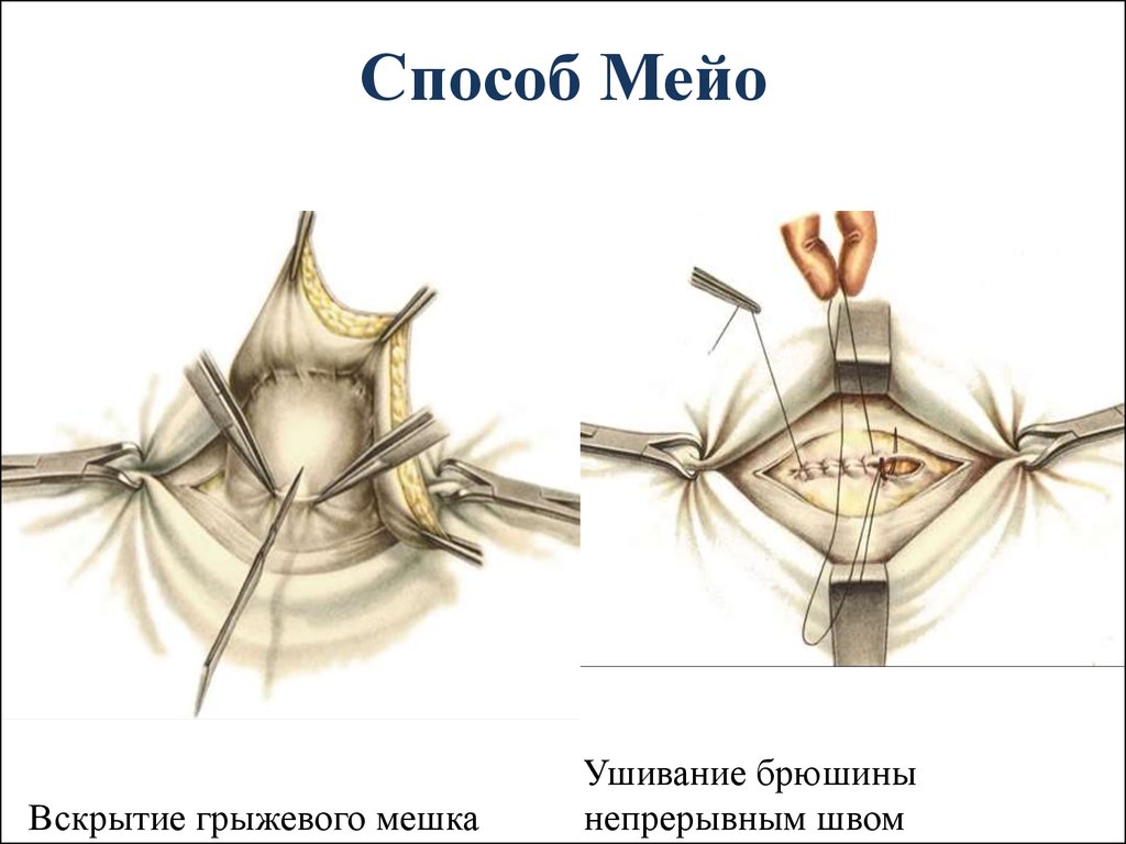 Пластика по мейо картинки