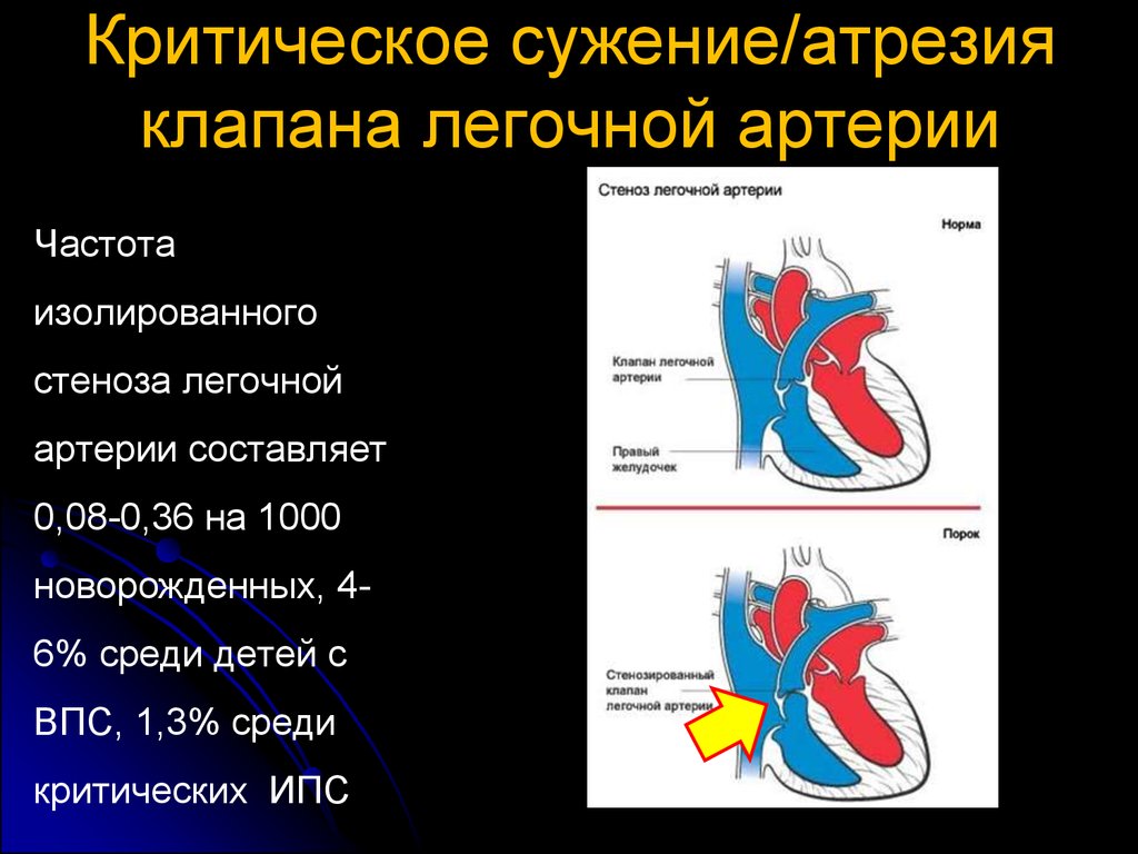 Стеноз у ребенка. Стеноз устья легочной артерии клиника. ВПС изолированный стеноз легочной артерии. ФКГ при стенозе клапана легочной артерии.