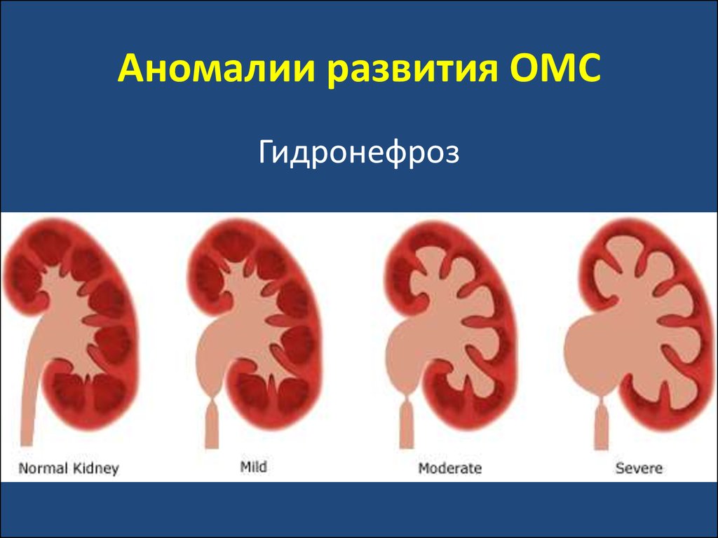 Каликоэктазия обеих почек