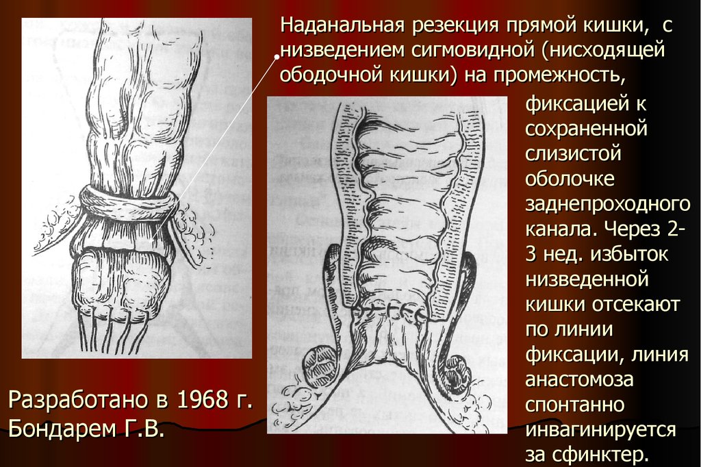 Презентация операции на прямой кишке