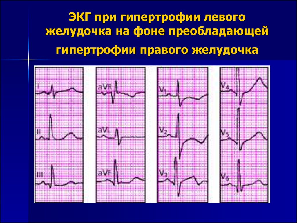 Неполная блокада пнпг. Блокада ПНПГ И передней ветви ЛНПГ на ЭКГ. Неполная блокада ЛНПГ на ЭКГ. ЭКГ блокада пучка Гиса классификация. Левожелудочковая гипертрофия ЭКГ.