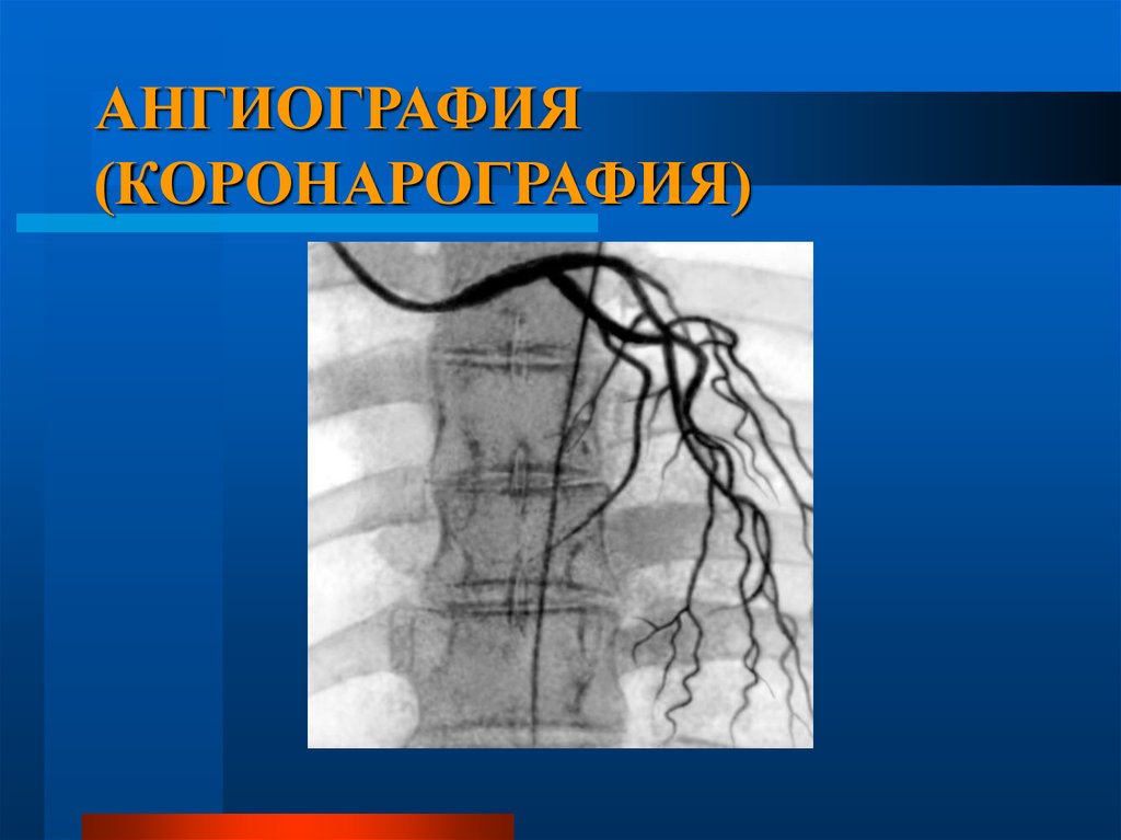 Коронография что такое. Рентгеноконтрастная коронарография. Артерии сердца на коронарографии. Коронарография атеросклероз. Ангиография коронарография.