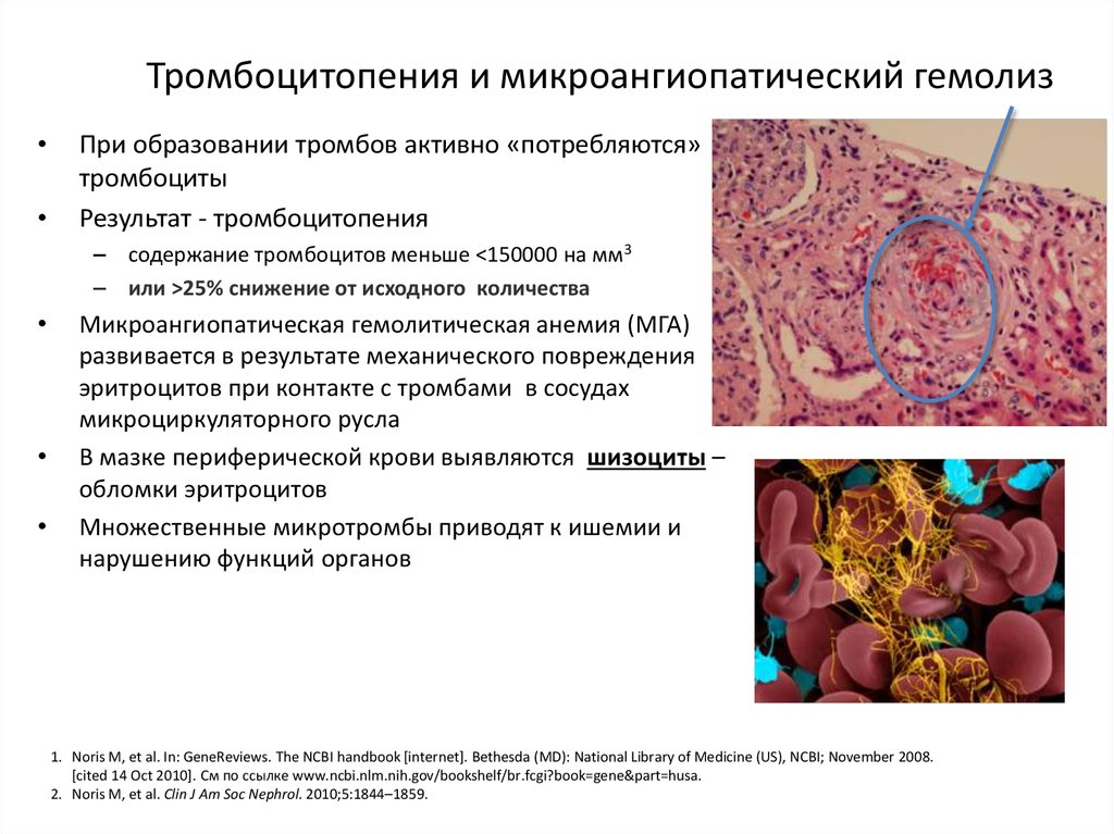 3 тромбоцитопения. Тромбоцитарная микроангиопатия. Микроангиопатическая анемия. Тромбоциты при гемолизе. Разрушение тромбоцитов причины.