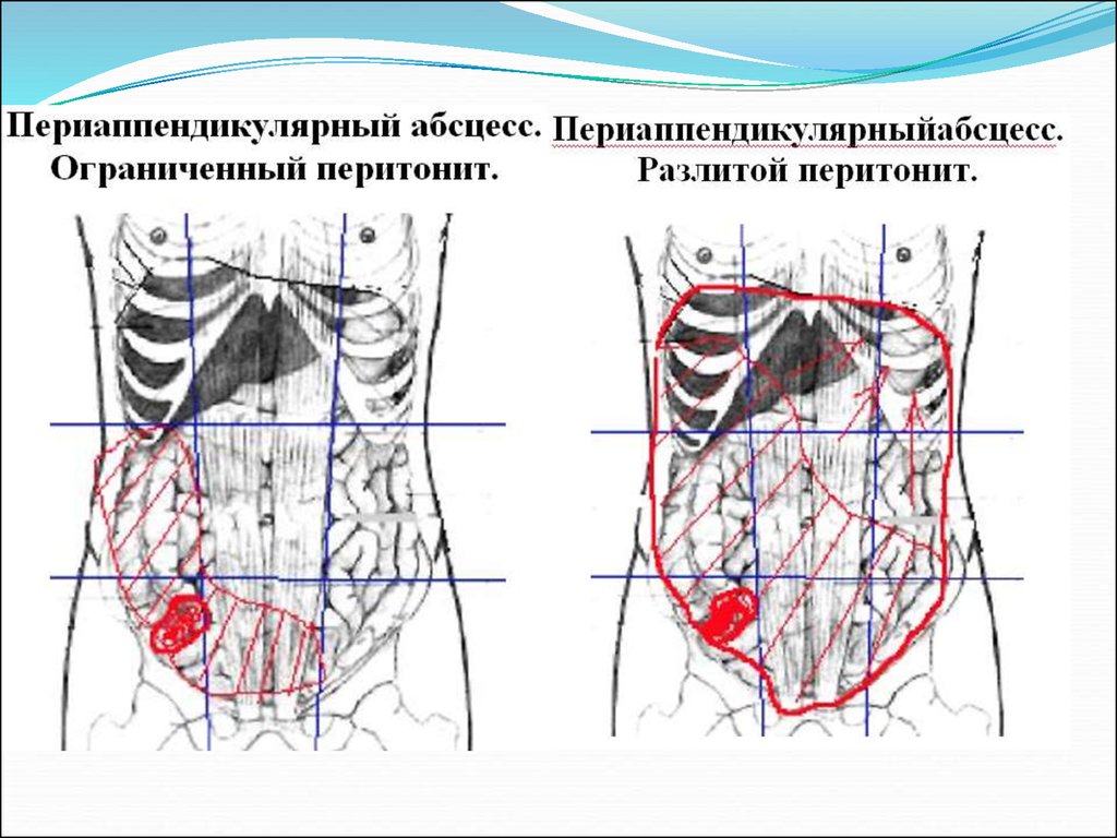 Схема распространения патологических процессов по брюшной полости