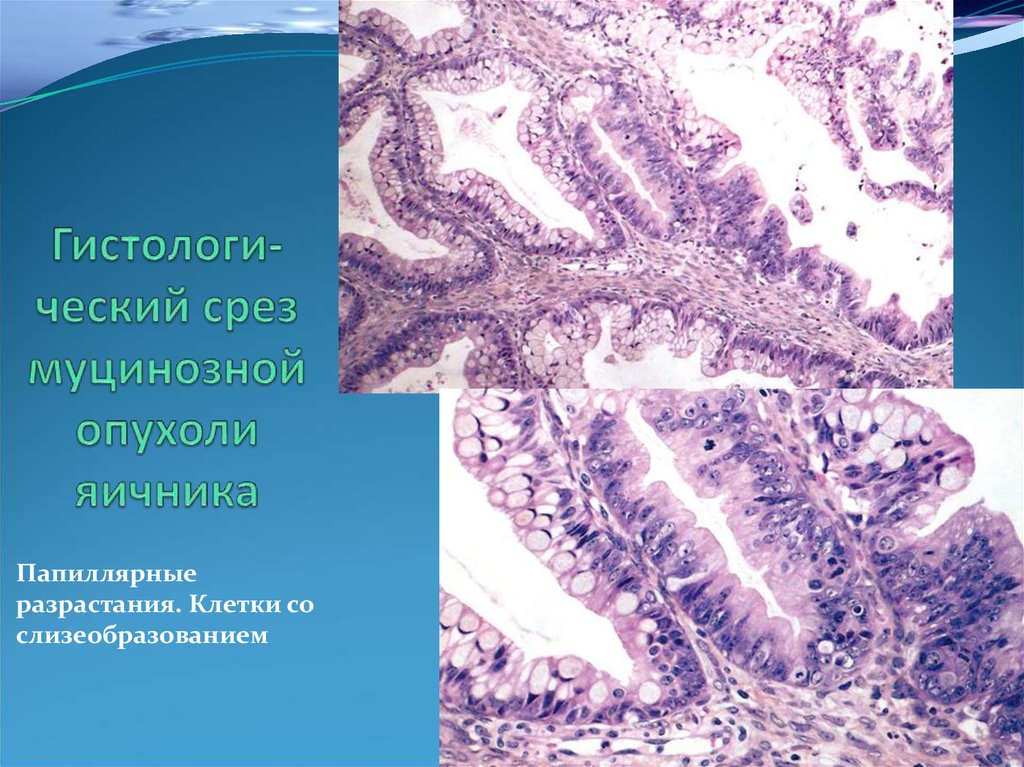 Муцинозный рак. Серозная цистаденокарцинома гистология. Папиллярная аденокарцинома гистология. Муцинозная аденокарцинома гистология. Серозная цистаденокарцинома яичника гистология.