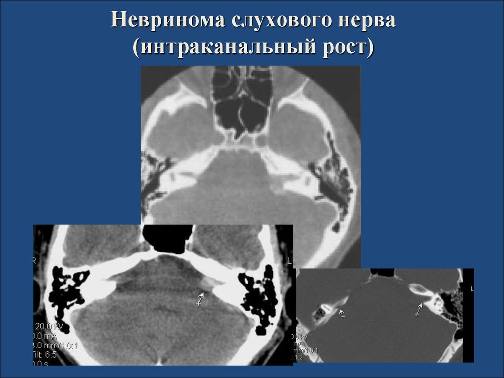 Невринома. Шваннома слухового нерва кт. Невринома слухового нерва кт. Кт при невриноме слухового нерва. Шваннома слухового нерва макропрепарат.