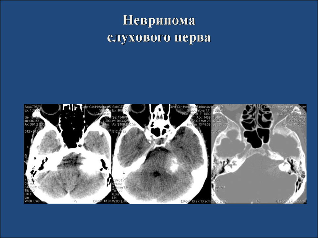 Невринома. Шваннома слухового нерва кт. Невринома слухового нерва кт. Кт при невриноме слухового нерва.