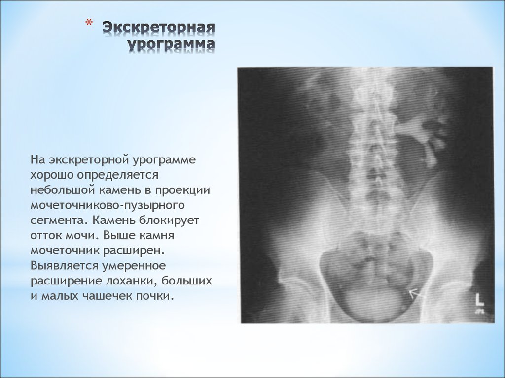 Умеренное расширение. Описание экскреторной урограммы. Пиелонефрит экскреторная урограмма. Экскреторная урограмма описание. Экскреторная урография расширение лоханок.