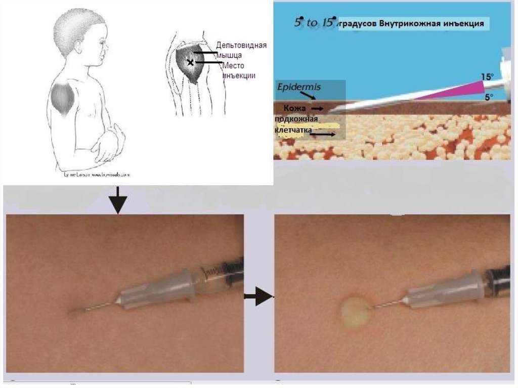 Картинки внутрикожной инъекции