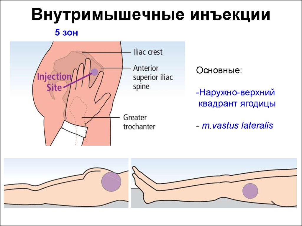 Уколы в бедро внутримышечно схема