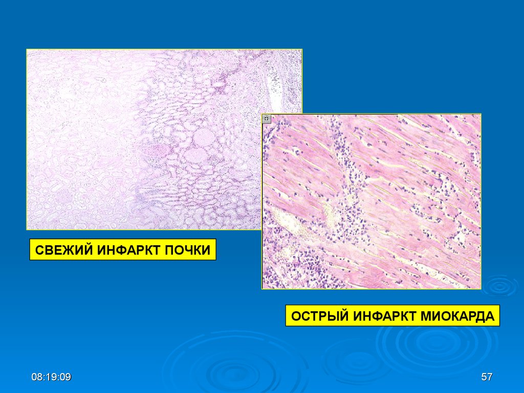 Ишемический инфаркт. Анемический инфаркт почки препарат. Анемический инфаркт почки микропрепарат. Ишемический инфаркт почки патанатомия. Ишемический инфаркт почки препарат патанатомия.