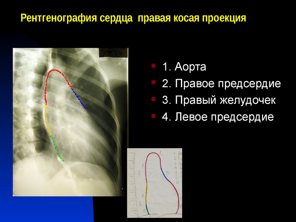 Рентгенография сердца. Рентген сердца. Рентгеновская анатомия сердца. Нормальная рентгенограмма сердца. Рентген сердца норма.