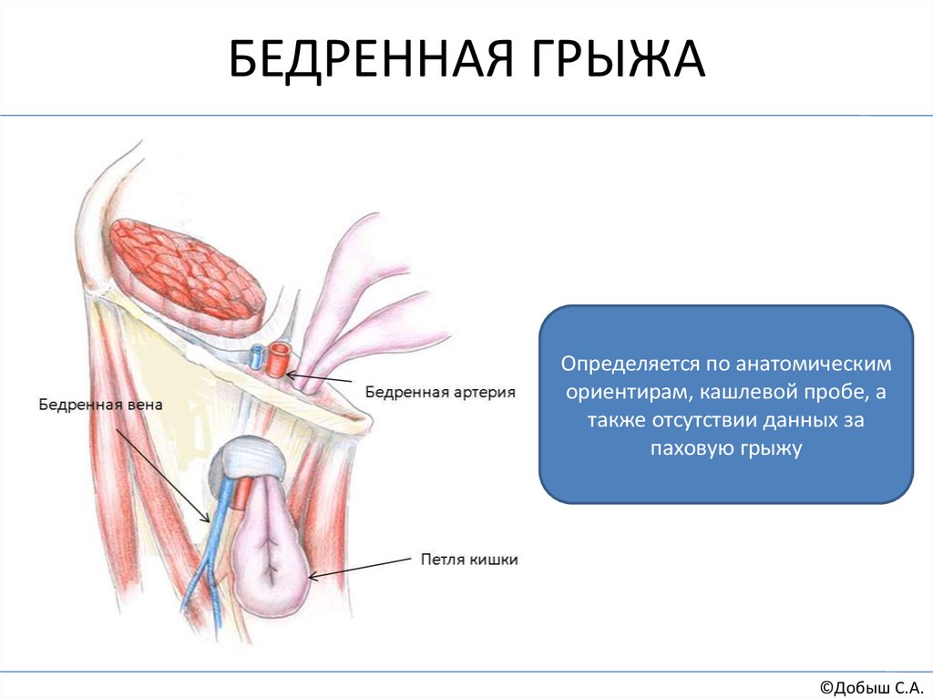 Бедренная грыжа. Бедренная грыжа содержимое мешка. Невправимая бедренная грыжа. Паховая и бедренная грыжа кт.