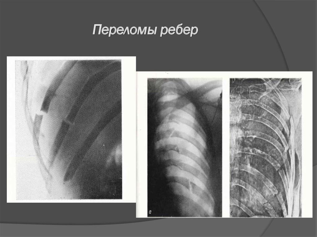 Симптомы трещины в ребре