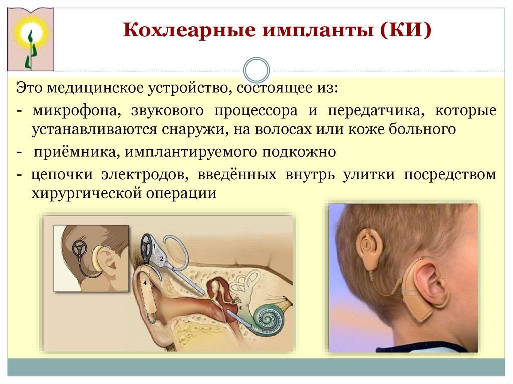 Кохлеарная имплантация. Кохлеарная имплантация операция. Кохлеарный аппарат. Операция кохлеарной имплантации что это такое.