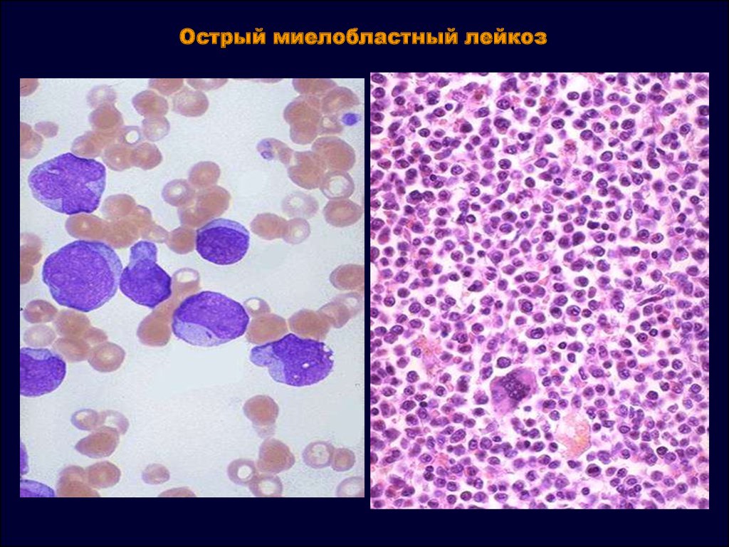 Картина острого лейкоза