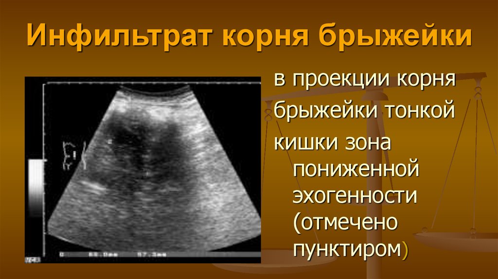 Повышенная эхогенность кишечника. Инфильтрация брыжейки. Инфильтрат корня брыжейки.