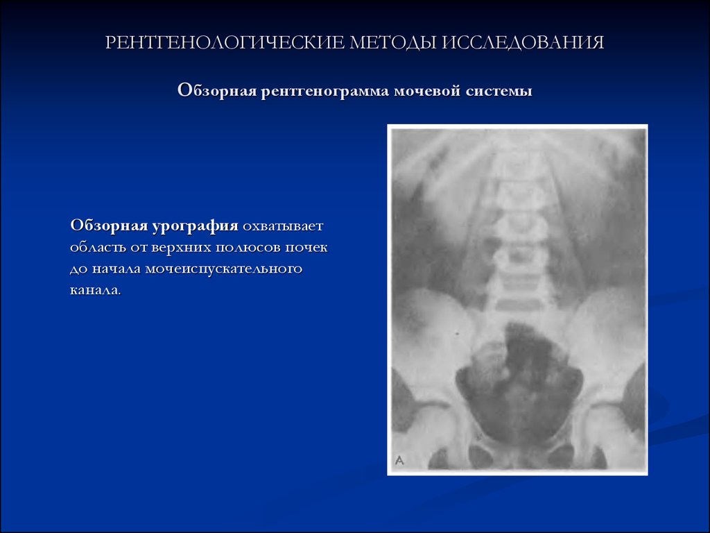 На качестве изображения мочевых путей при экстренной урографии отражается