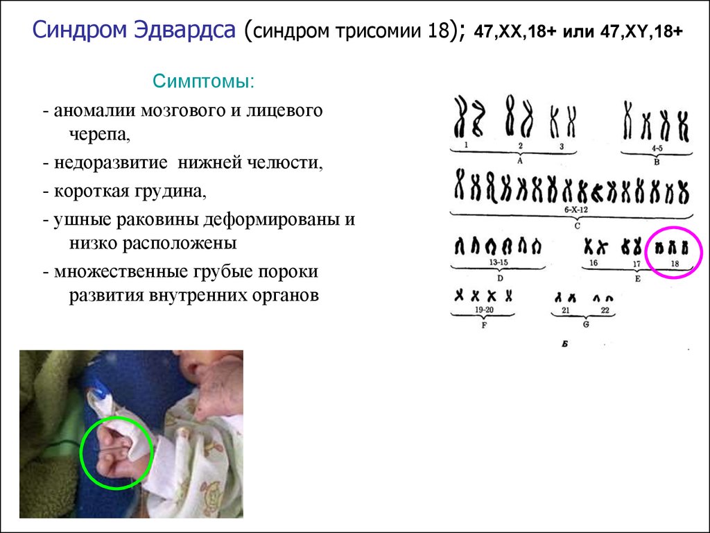 Признак 18. Кариотип больного с синдромом Эдвардса. Синдром Эдвардса или трисомия по 18 хромосоме;. Синдром Эдвардса клинические проявления. Синдром Эдвардса кариотип симптомы.