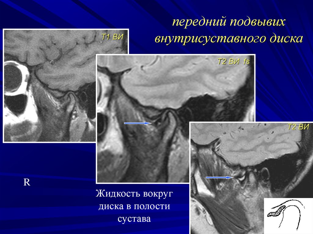 Мрт внчс. Вывих диска височно-нижнечелюстного сустава. Подвывих суставного диска височно-нижнечелюстного сустава. Вывих и подвывих височно-нижнечелюстного сустава.