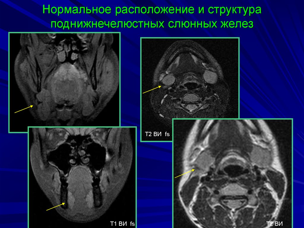 Нормальное расположение. Сиалоаденит околоушной железы мрт. Околоушная слюнная железа кт. Проток околоушной слюнной железы на кт.