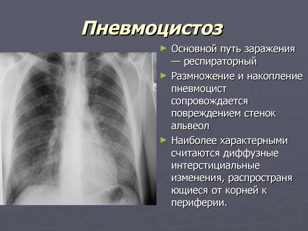 Пневмония пути. Пневмоцистная пневмония рентген. Пневмоцистная пневмония рентген описание. Пневмоцистоз патогенез. Пневмоцистная пневмония у ВИЧ инфицированных рентген.