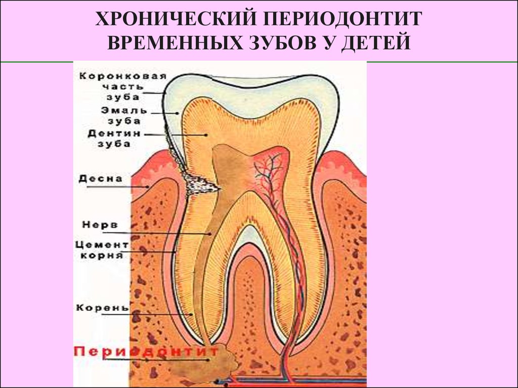 Периодонтит и пульпит разница