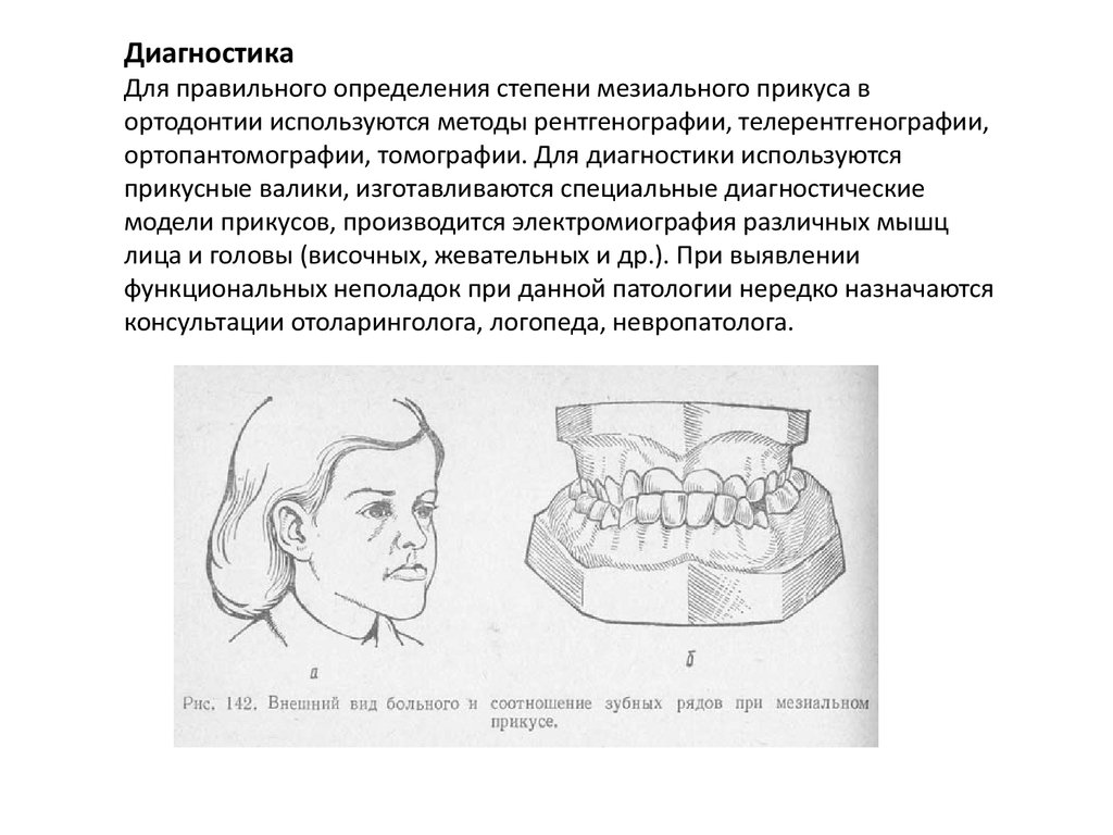 Мезиальный прикус это