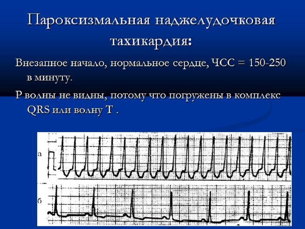 Тахикардия что. Пароксизмальная наджелудочковая тахикардия ЭКГ. ЭКГ при пароксизмальной наджелудочковой тахикардии. Наджелудочковая тахикардия на ЭКГ. ЭКГ при наджелудочковая тахикардия.