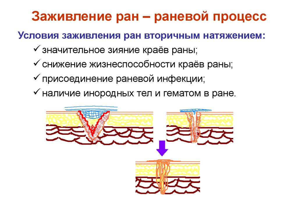 Этапы заживления. Заживление РАН – раневой процесс. Стадий заживления РАН вторичным натяжением. Процесс заживления раны вторичным натяжением. Заживление вторым натяжением.