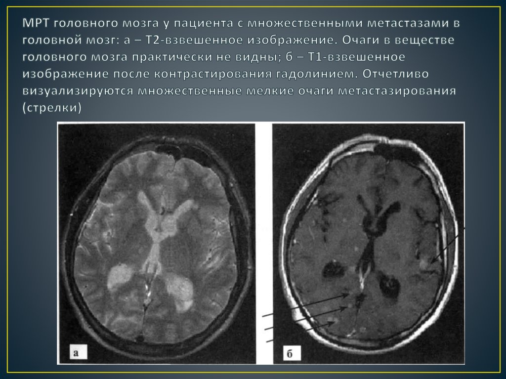 Картина очаговых изменений вещества головного мозга дистрофического характера