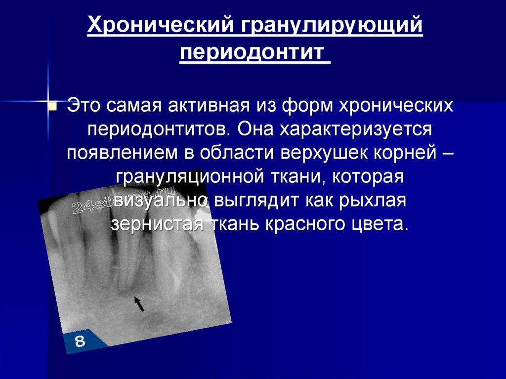 Для рентгенологической картины фолликулярной кисты характерна деструкция костной ткани в виде