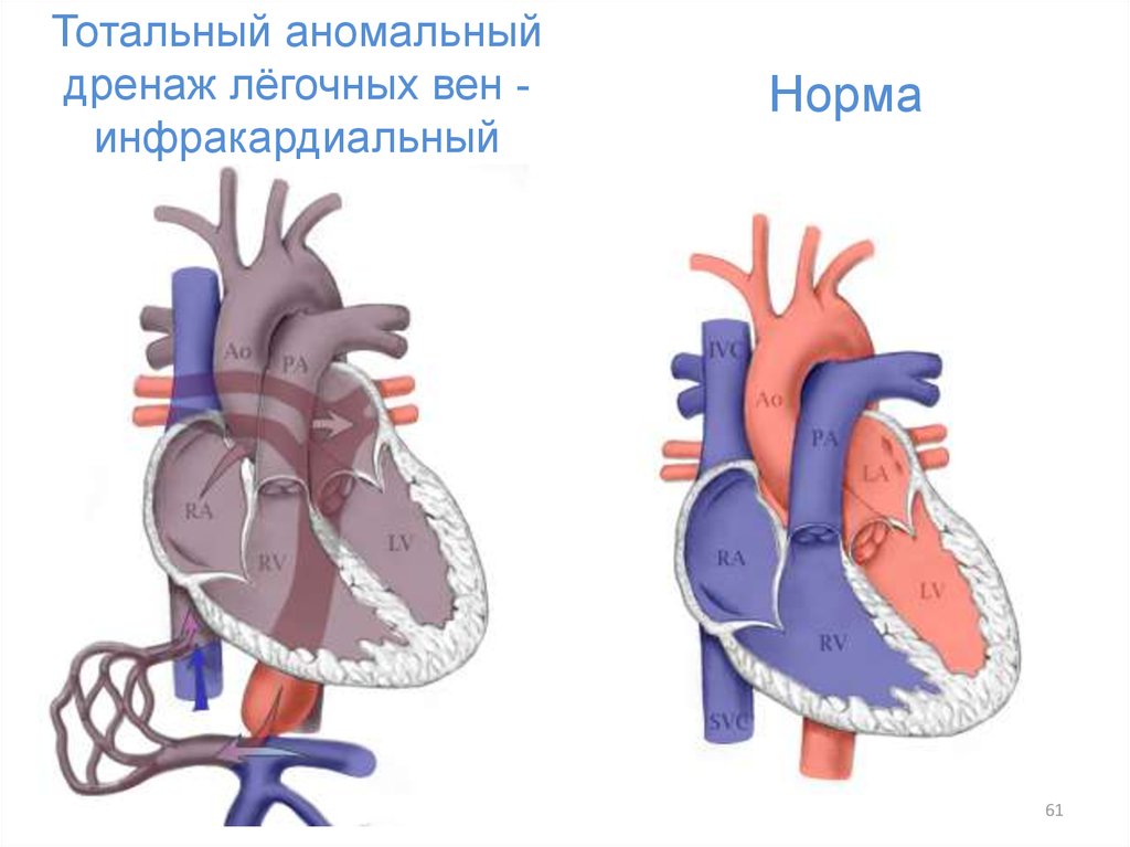 Врожденный венозный порок. Инфракардиальный аномальный дренаж легочных вен. Аномалии дренажа легочных вен. Аномальное впадение легочных вен. Частичный аномальный дренаж легочных вен (ЧАДЛВ).