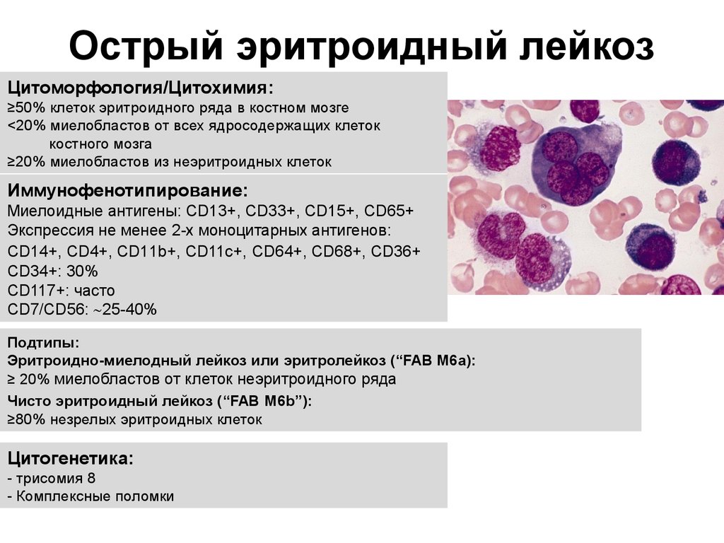 Виды острых лейкозов характеристика картины крови при них