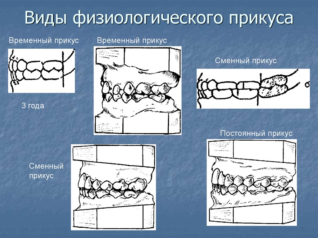 Патологический прикус