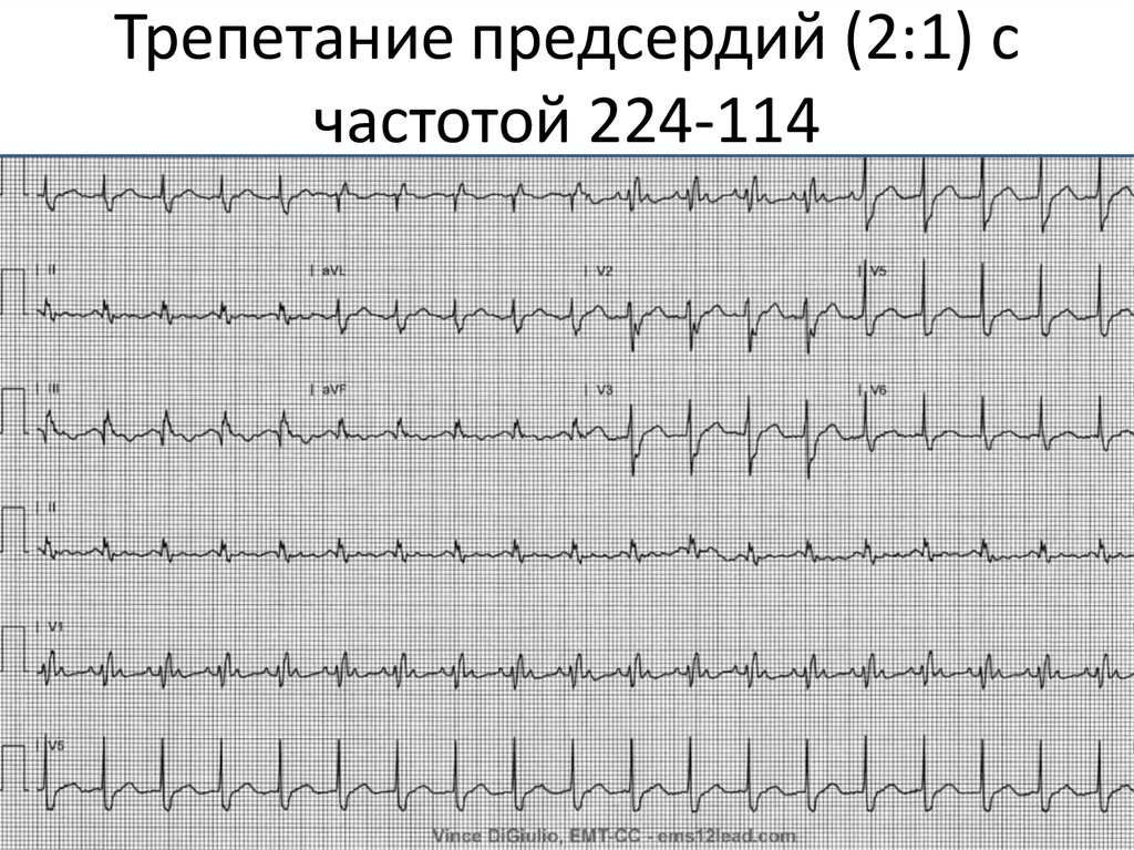 Трепетание предсердий. Трепетание предсердий 1 к 1 на ЭКГ. Трепетание предсердий 3 к 1 на ЭКГ. Трепетание предсердий 2 к 1 на ЭКГ. Трепетание 2 1 на ЭКГ.