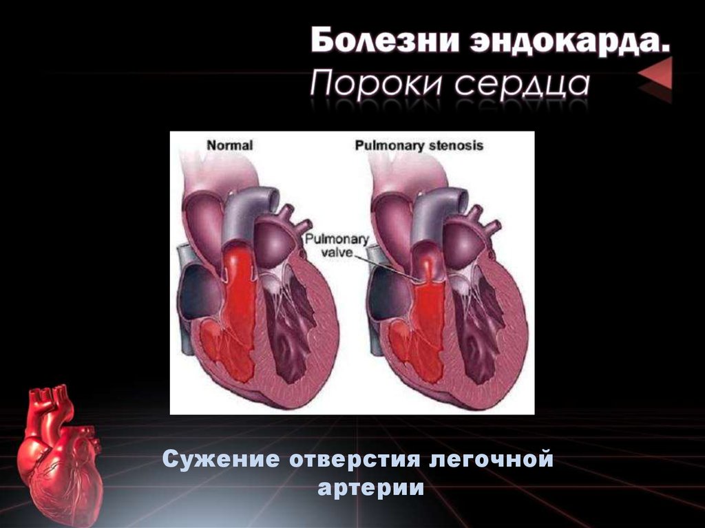 Порог сердца что это. Приобретенные пороки сердца. Заболевания пороков сердца.