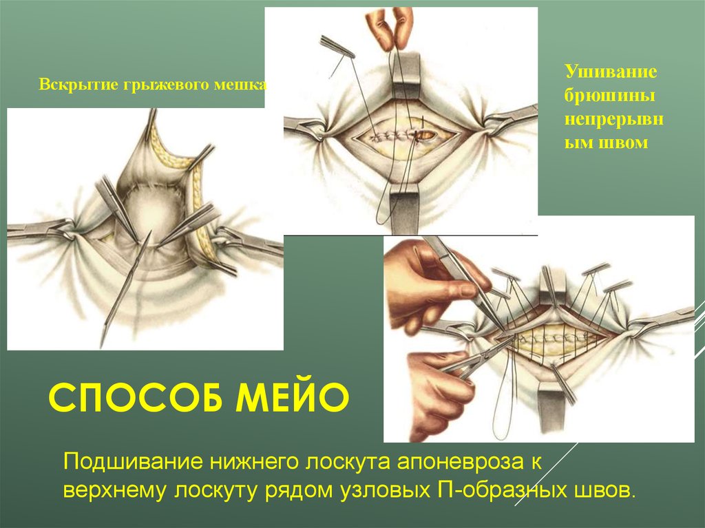 Пластика грыж. Пупочная грыжа операция Сапежко и Мейо.