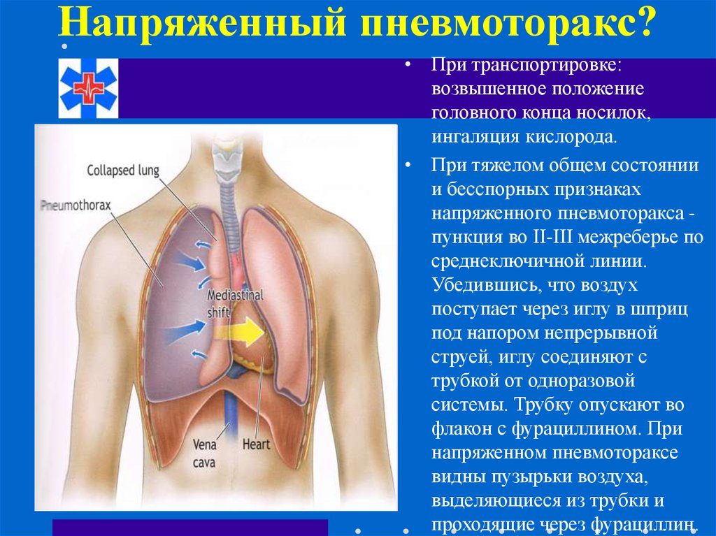 Спонтанный пневмоторакс карта смп